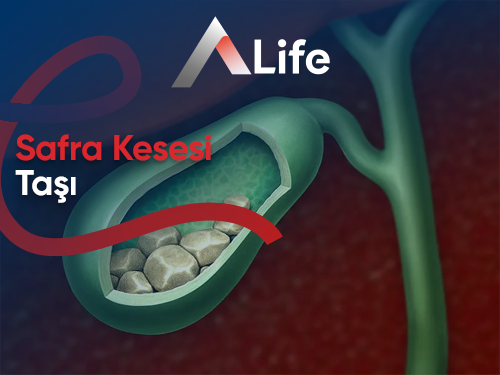 Safra Kesesi Taşı